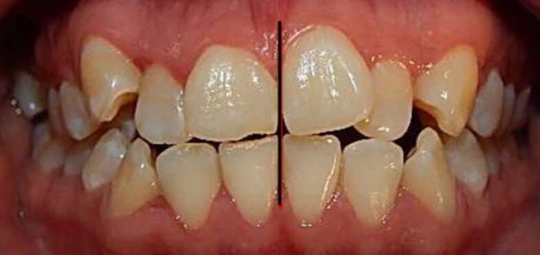 Fig.5 Intraoral Izquierda