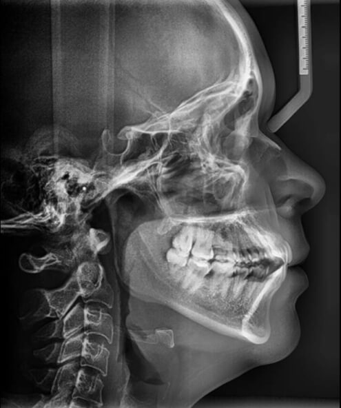 Fig. 6 Radiografia lateral de craneo