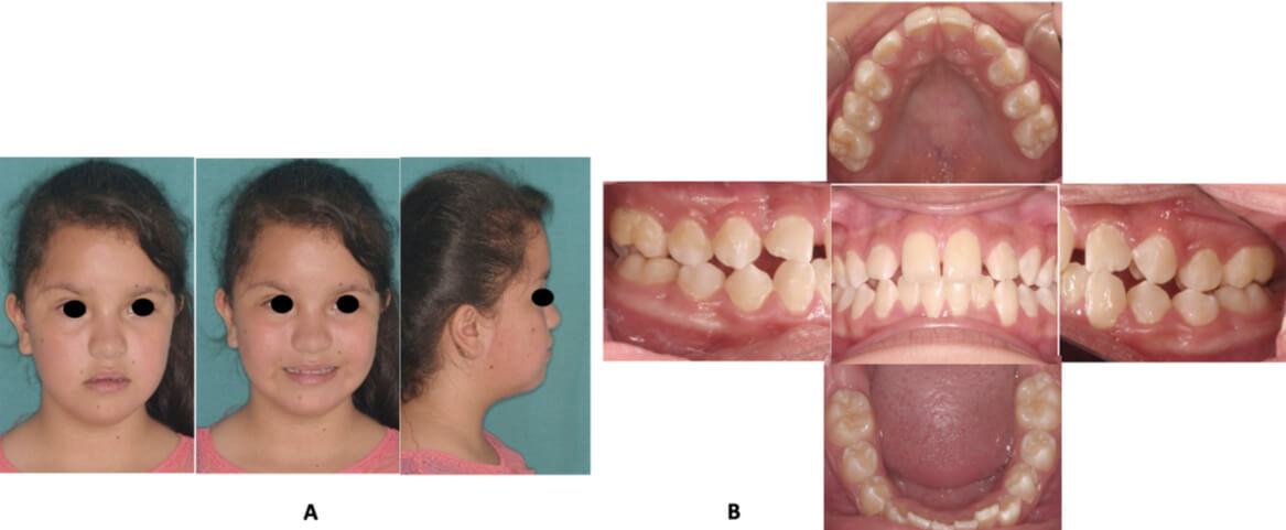 Figura 1. Fotografías iniciales. A) Extraorales: Frente, sonrisa y perfil. B) Intraorales: frontal, oclusal y laterales.