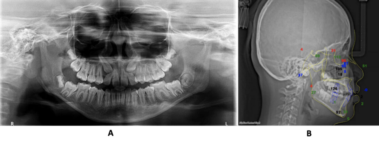 Figura 3. Radiografías y trazados iniciales. A) Ortopantomografía. B) Trazado Cefalométrico.