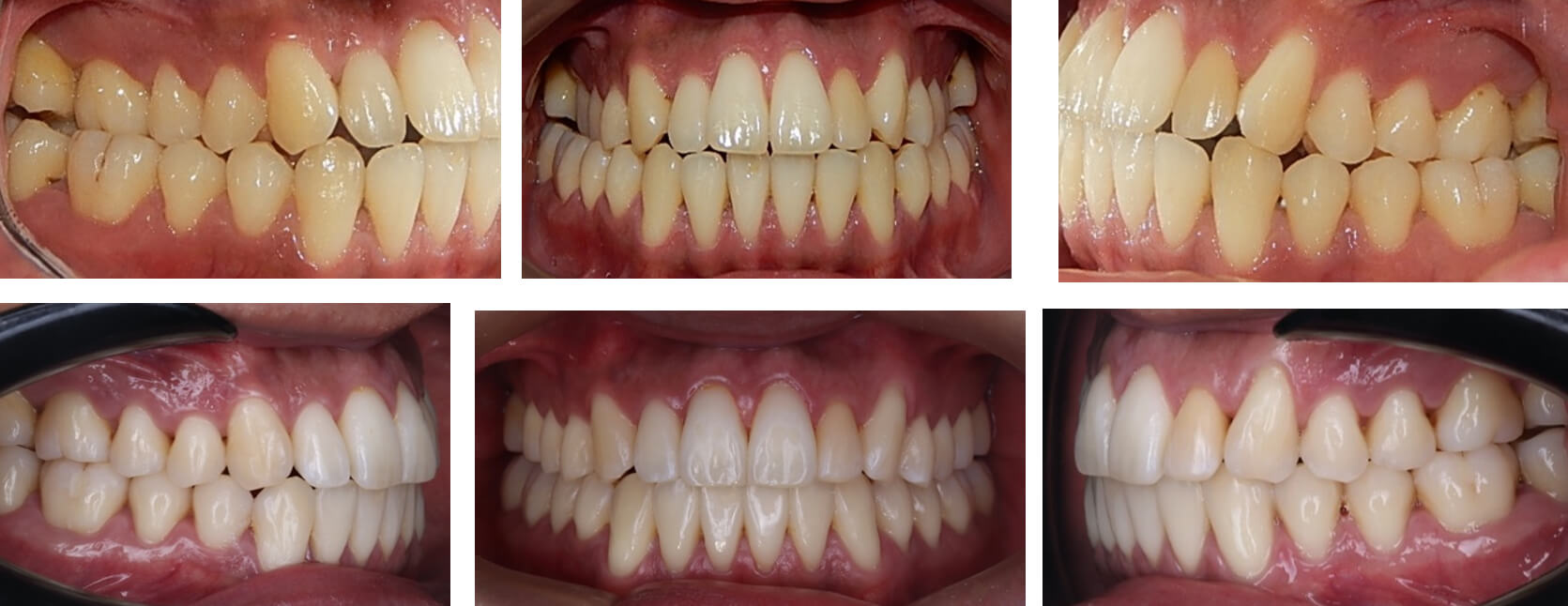 Fig.12 comparación inicio y resultados finales.