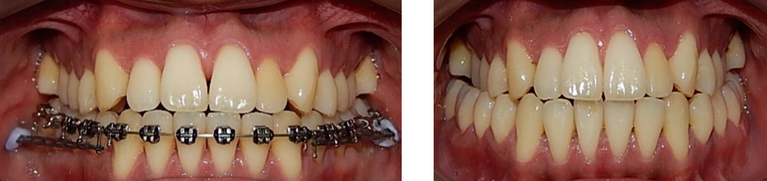 Fig. 3 frente, ya sin los braquetes