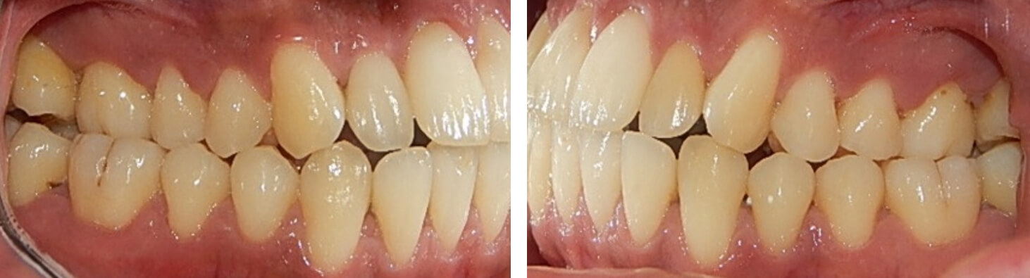 Fig. 4  Intraoral lateral  derecha e izquierda