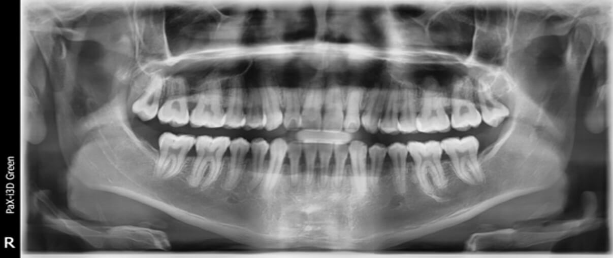 Fig. 5 radiografía  panorámica inicial