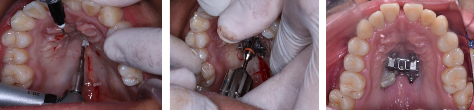 Fig. 6 microosteoperforaciones