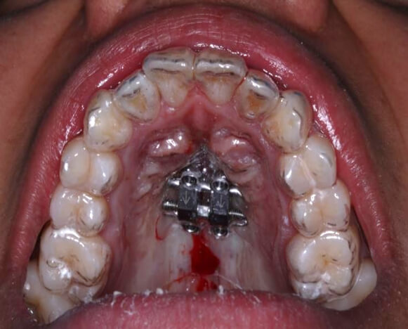 Fig. 7 Distalización inferior bilateral con microtornillos 2x12 mm