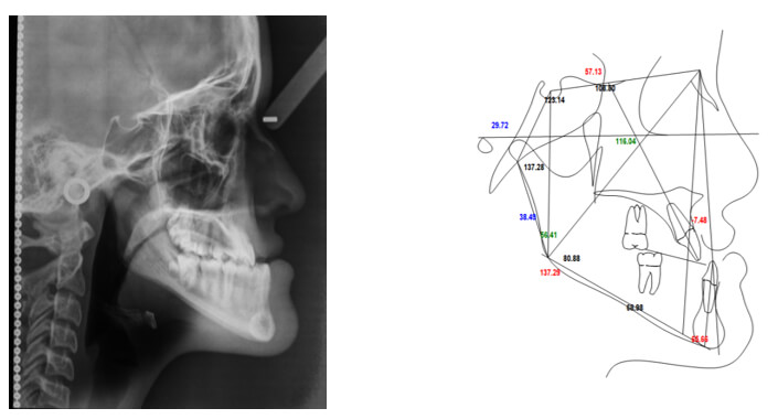 Radiografía Cefálica lateral inicial. Fig (3)
