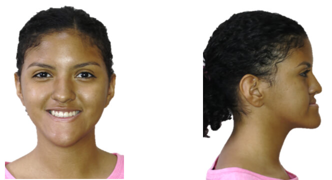 Vista frontal y de perfil antes de la desprogramación. Fig (7)