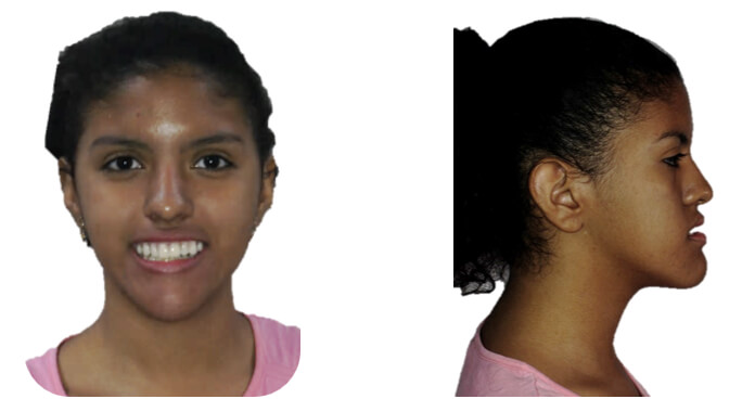 Vista frontal y de perfil después de la desprogramación. Fig (8)