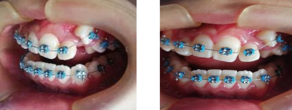 Fig.12. Vista del control a los 6 meses Después de conseguir la transposición del canino superior y llevarlo en una posición adecuada se inicia colocando el brackets correspondiente para la pieza canina, y se empieza a retraer con alambre redondo N°14.