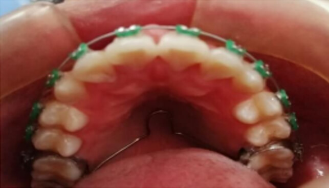 Fig.15. Vista del control a los 15 meses Se puede observar la correcta posición del canino dentro del arco dentario, conservando una buena alineación de los dientes.