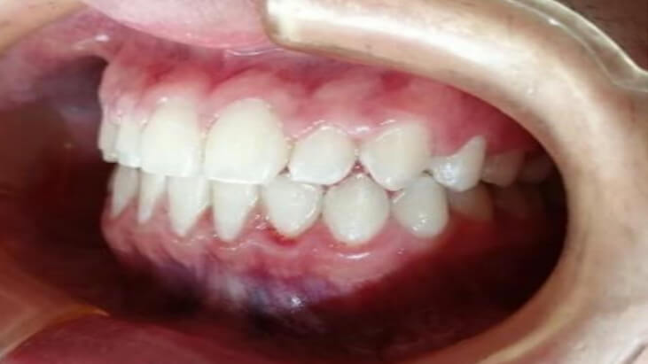 Fig.16. Tratamiento final Se puede observar la correcta alineación y posición del canino superior izquierdo logrando una buena relación canina y na estética adecuada, conservando la salud periodontal y gingival.