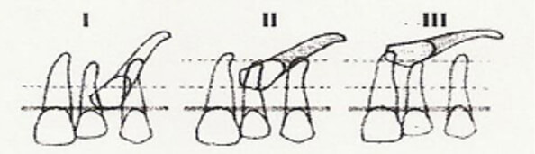Fig. 2 Trujillo, JJ. Retenciones dentarias en la región anterior. Práctica Odontológica. 1990;11:29-35