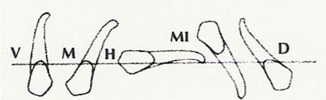 Fig.3 Retenciones dentarias en la region anterior. TArujillo J.J Practica Odontologica