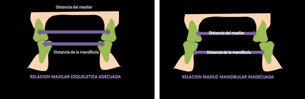 Figura 3 A. Relación maxilar esquelética adecuada: Mayor distancia maxilar en relación a  distancia mandibular. B. Menor distancia maxilar en relación distancia mandibular