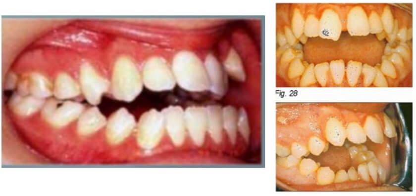 IMAGEN 2: Aquí observamos la mordida abierta falsa de tipo dental que abarca generalmente desde canino y su pronóstico llega a ser bueno y en la segunda imagen, mordida abierta verdadera o esquelética abarca hasta nivel de premolares esto indica que su pronóstico es reservado ya que muchas veces llega a ser un tratamiento quirúrgico.