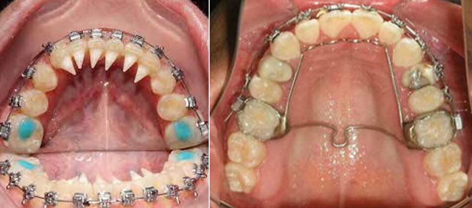 IMAGEN 3: Observamos algunos tratamientos para la corrección de habito de lengua que origina en muchos de sus casos una mordida abierta.