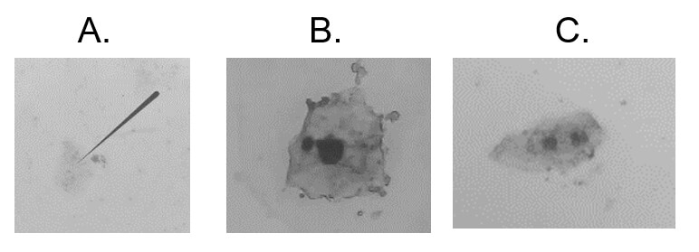 FIGURA No 3: Alteraciones genotóxicas observadas en este estudio en células epiteliales exfoliadas de la mucosa oral. A: Célula binucleada, B: Célula Cariolítica, C: Micronúcleo.