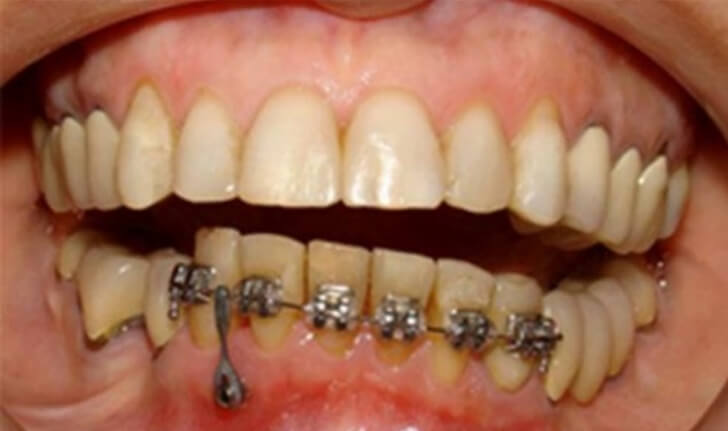 Figura 2. Intrusión dentaria en grupo incisivo para resolver problemas del plano mandibular (Tomada de Martino F 2009).