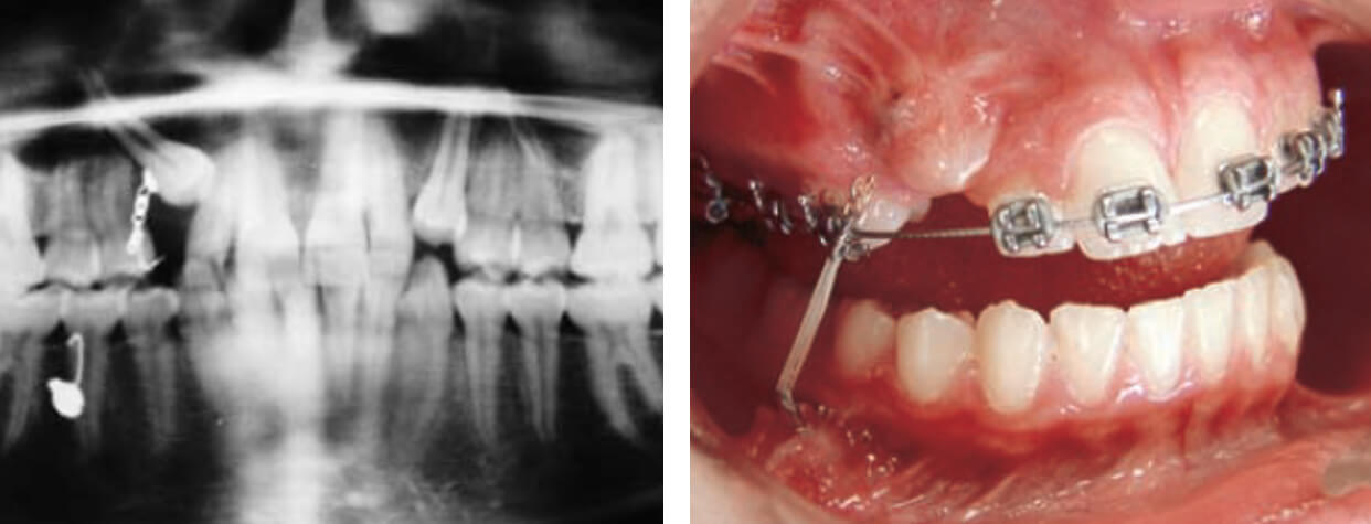 Figura 5. Radiografía tras la tracción del canino y tras 11 meses de tratamiento, momento en que la corona del canino está a punto de perforar la mucosa oral. (Tomada de Molina 2004).