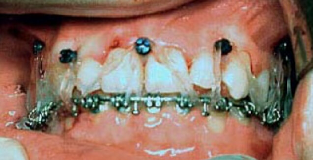 Figura 6. Fijación intermaxilar y gomas (Tomada de Br J Oral Maxilofac Surg 2007).