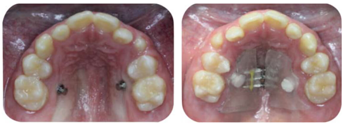 Figura 7. Sitios de inserción de los mini implantes y la placa de acrílico despegada de las piezas dentarias (Tomada de Puebla 2015).