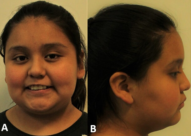 Fig. 2.A. Vista extraoral frontal; 2. B. Vista extraoral perfil