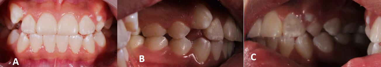 Fig. 3.A. Vista intraoral frontal; 3. B. Vista Lateral Derecha 3.C. Vista Lateral Izquierda