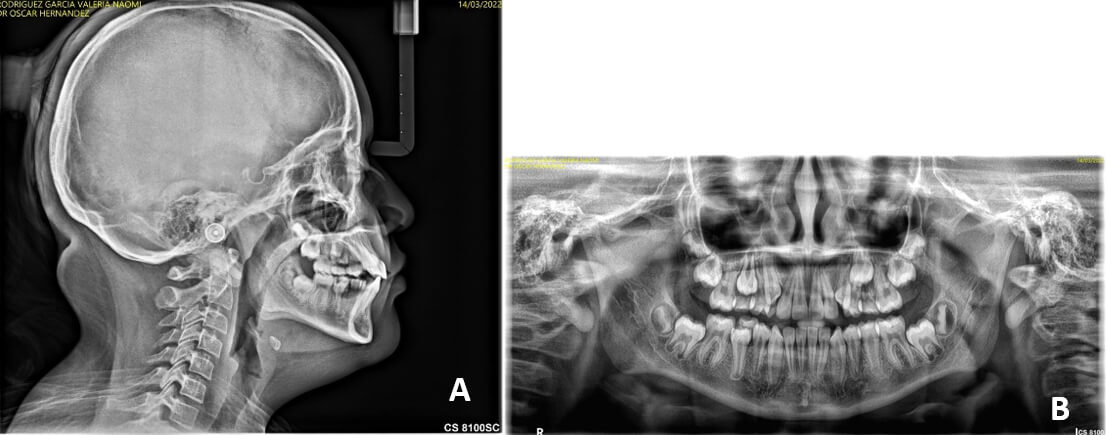 Fig. 4.A Radiografía lateral de cráneo inicial. Fig. 4.B. Radiografía panorámica