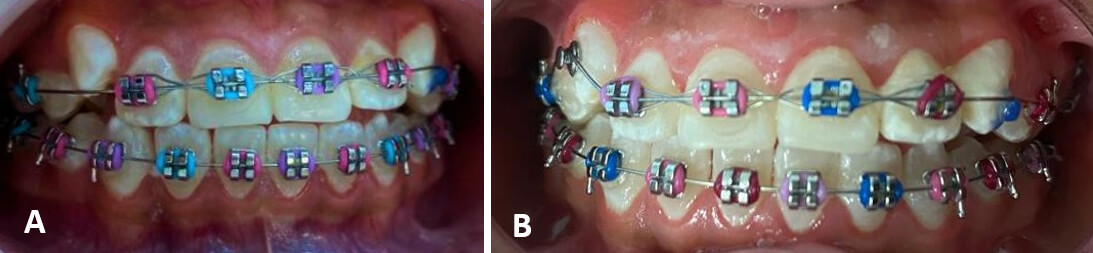 Fig. 5.A Vista Intraoral Derecha 5.B Vista Intraoral Izquierda