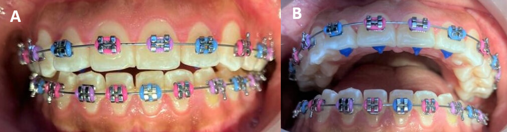 Fig. 6.A Vista Intraoral de Frente 6.B Vista Intraoral Oclusal Superior