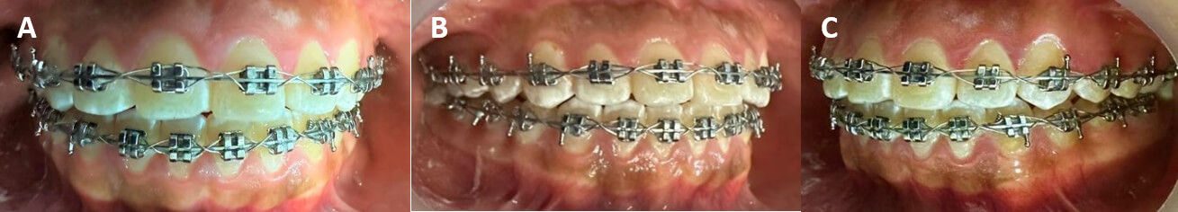 Fig. 7.A. Vista intraoral frontal; 7.B. Vista Lateral Derecha 7.C. Vista Lateral Izquierda