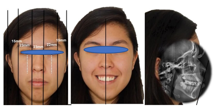 Fig. 1 frente en reposo, sonrisa ,perfil