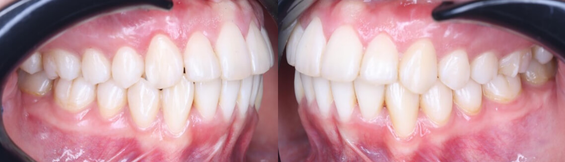 Fig. 11 Lateral final derecha e izquierda