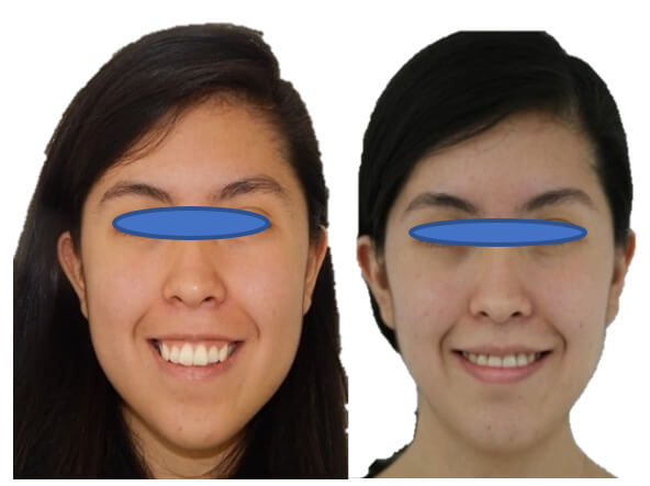 Fig. 13 Sonrisa al inicio y final del tratamiento