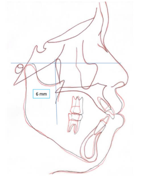 Fig. 14 Sobreimposición inicio-final