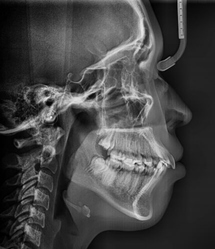 Fig.2 Radiografía lateral de cráneo