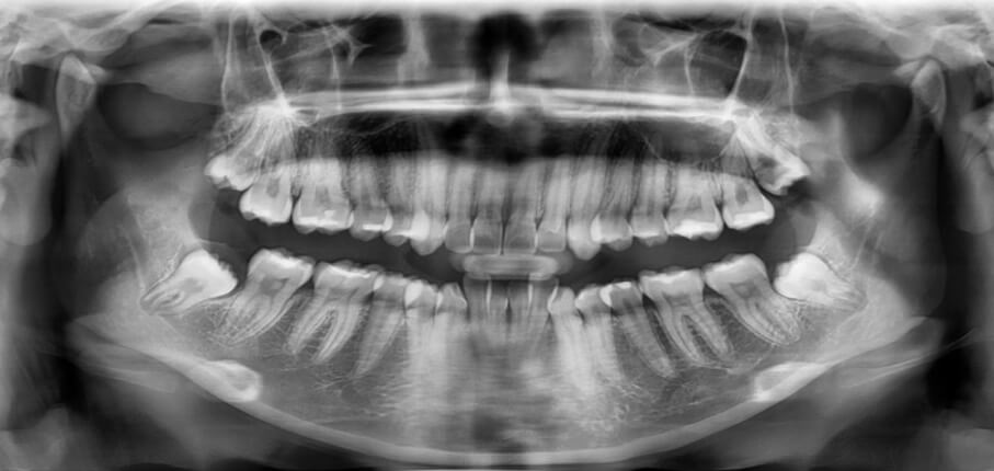 Fig.3 Radiografía panorámica