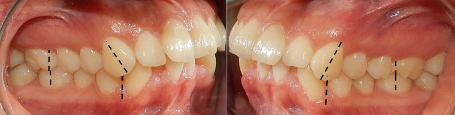 Fig. 5 Lateral derecha e izquierda