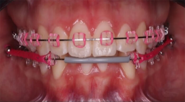 Fig. 7 Microtornillos en Shelf mandibular