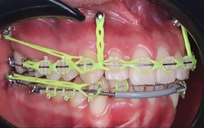 Fig. 8 Microtornillos en IZC e Interradiculares