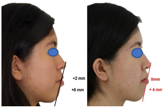 Fig. 9 De perfil inicio-final.