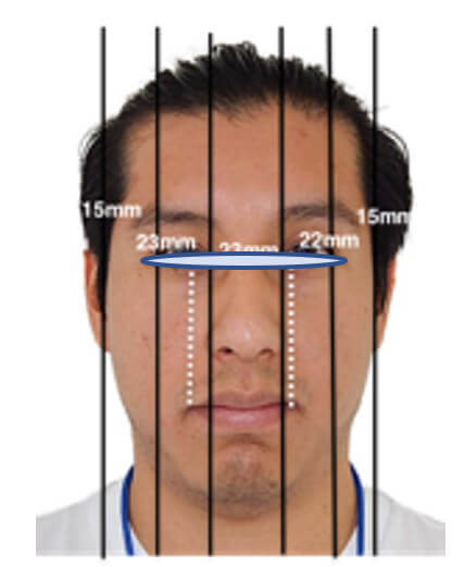 Fig.1 extraoral de frente