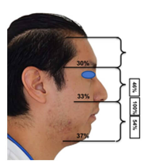 Fig.2 extraoral de perfil