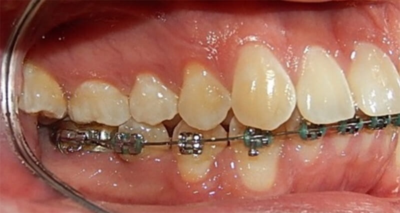 Fig. 3 intraoral derecha