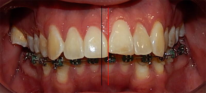 Fig. 4. Intraoral de frente