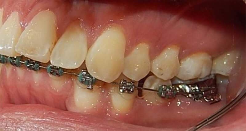 Fig.5 intraoral izquierda