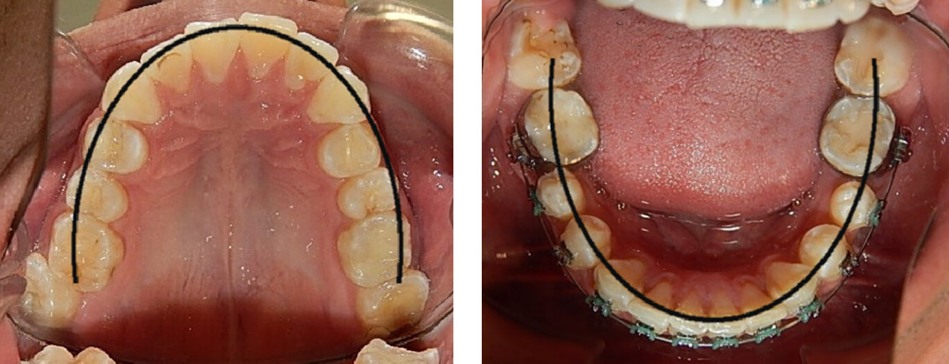 Fig. 6 oclusal superior e inferior