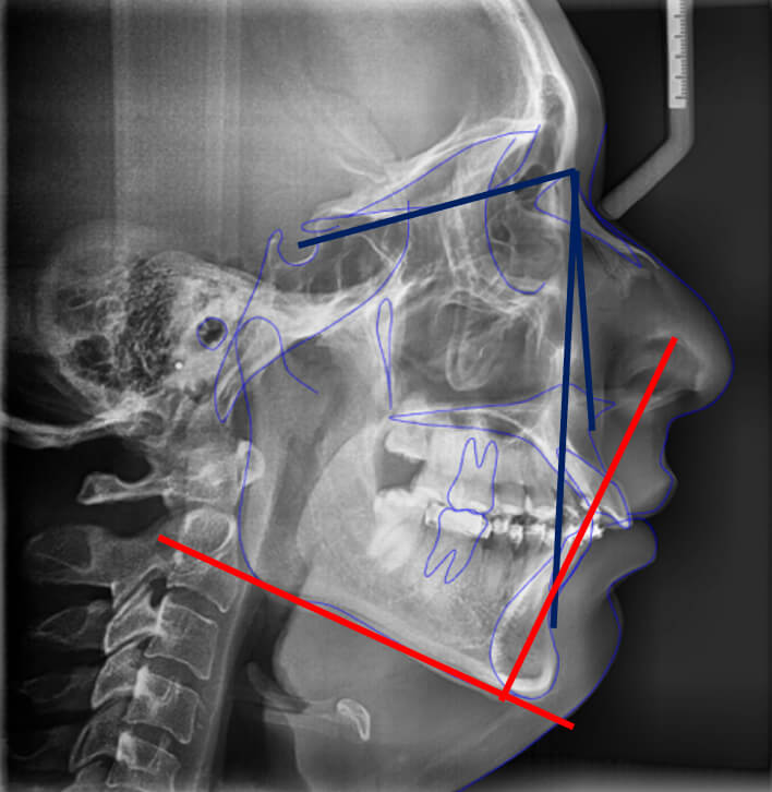 Fig.7 lateral de cráneo