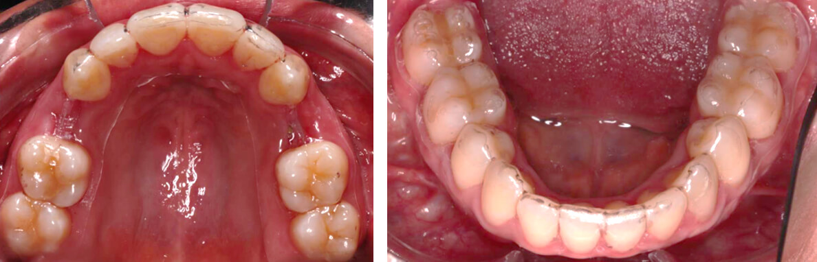 Fig.9  vista oclusal superior e inferior.